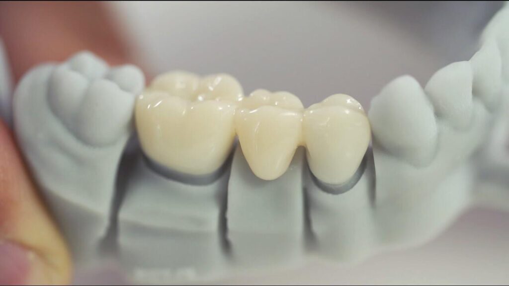 the role of sla 3d printing in dentistry