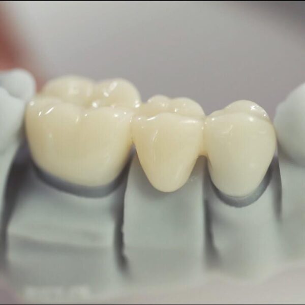 Digital Light Processing for Polymer Parts Manufacturing the role of sla 3d printing in dentistry